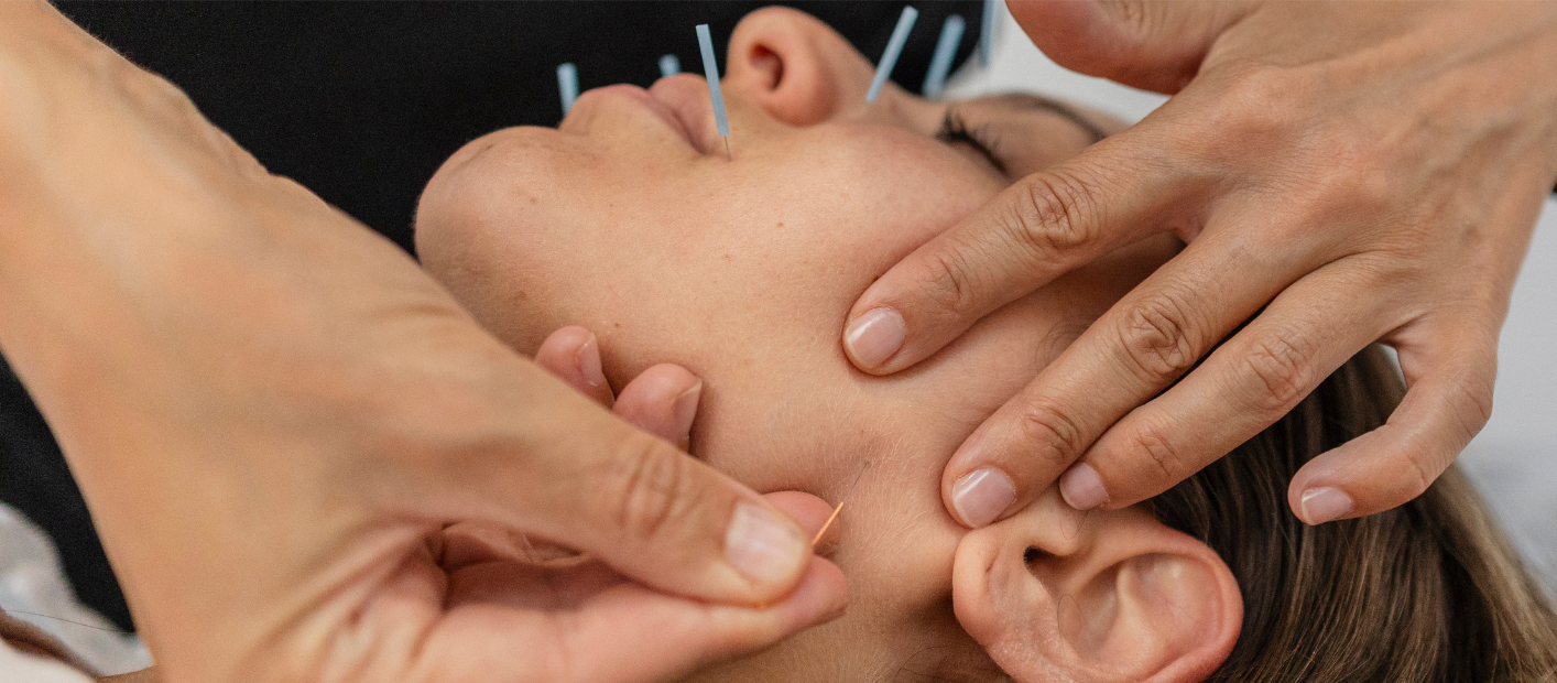Acupuntura estética facial